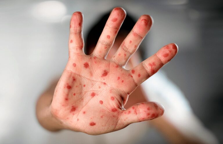 Aumentan los casos de Mpox en el país: 15 confirmados en lo que va del año